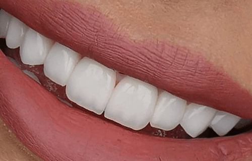 کامپوزیت دندان لبخند شما را زیبا میکند