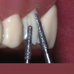 تفاوت روکش فلزی و روکش تمام سرامیک دندان از دیدگاه دندانپزشکان