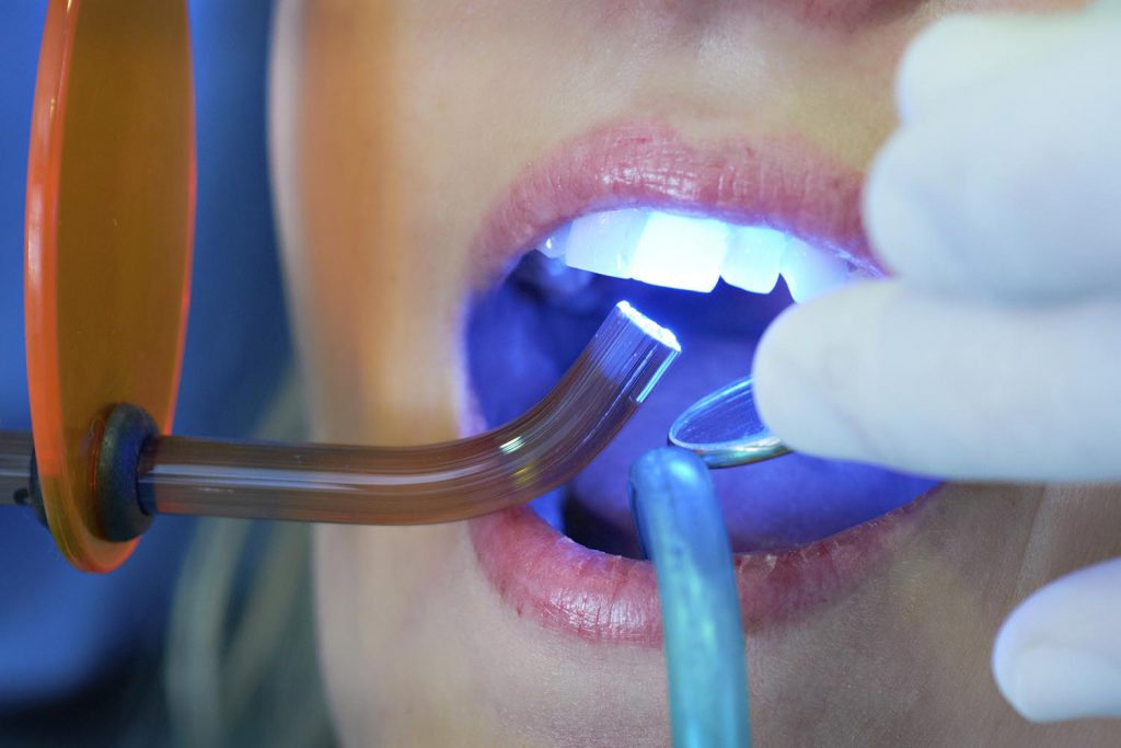 دکتر دندانپزشک زیبایی بعد برای سفت شدن  کامپوزیت دندان از نور آبی مخصوص استفاده می‌کند.