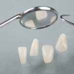 فرق کامپوزیت و لمینت دندان چیست؟| طول عمر را فدای هزینه نکنید