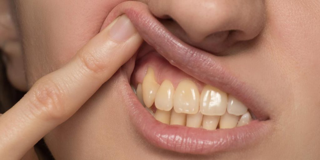 دندان‌های زرد شده باعث پایین آمدن اعتماد به نفس افراد می‌شود.