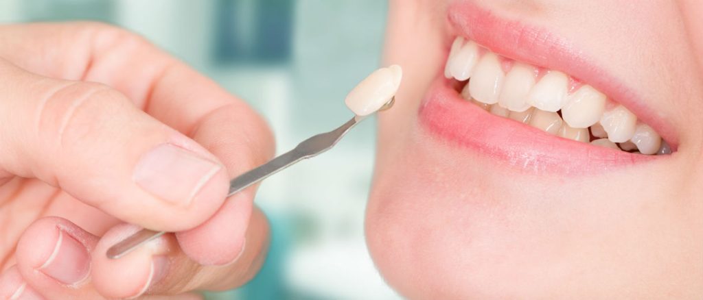 انتخاب بهترین روش طرح اصلاح یا لمینت دندان خرگوشی، به عهده پزشک می‌باشد.