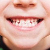 سن مناسب برای کامپوزیت دندان چه زمانی است؟