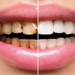 راهنمای جامع مراقبت از لمینت دندان + 3 باور اشتباه درباره نگهداری ازلمینت