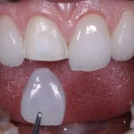 لمینت دندان خرگوشی  (Buck teeth laminate) چیست | نحوه انجام اصلاح دندان خرگوشی
