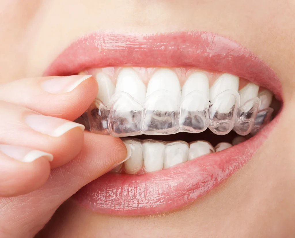 محافظ ژله‌ای دندان بیشتر برای مراقبت از لمینت دندان برای افرادی که دندان قروچه دارند استفاده می‌شود. 