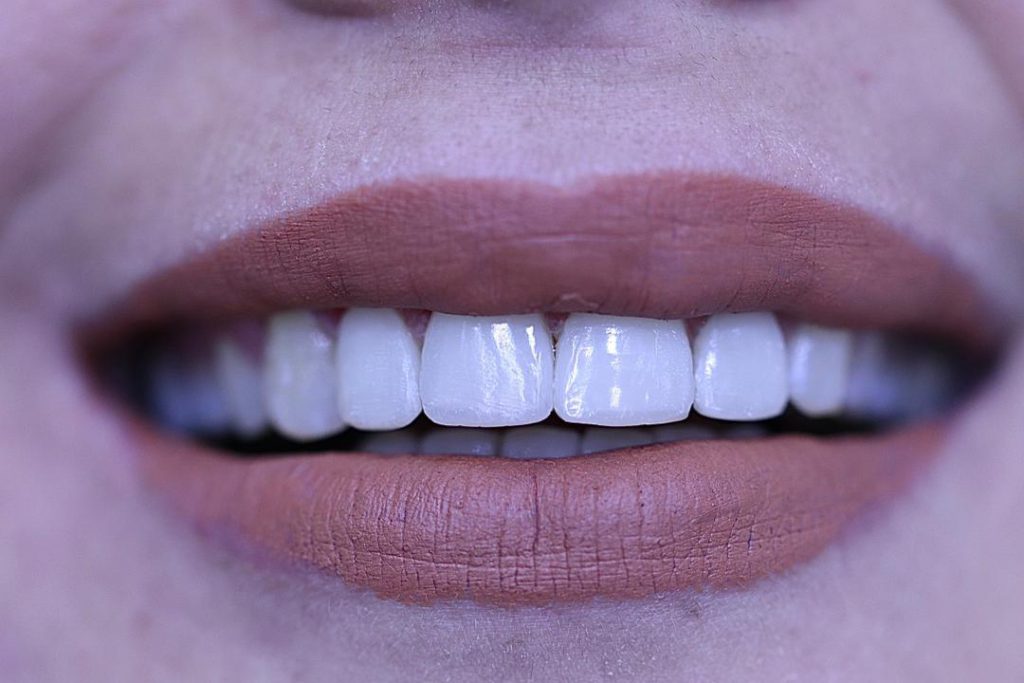 دندان هایی مرتب با استفاده از خدمات دندانپزشک زیبایی