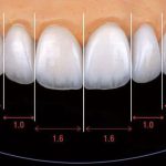 لمینت لبه شیشه‌ای یا لبه شفاف: تکنیک نوین در دندان‌پزشکی زیبایی
